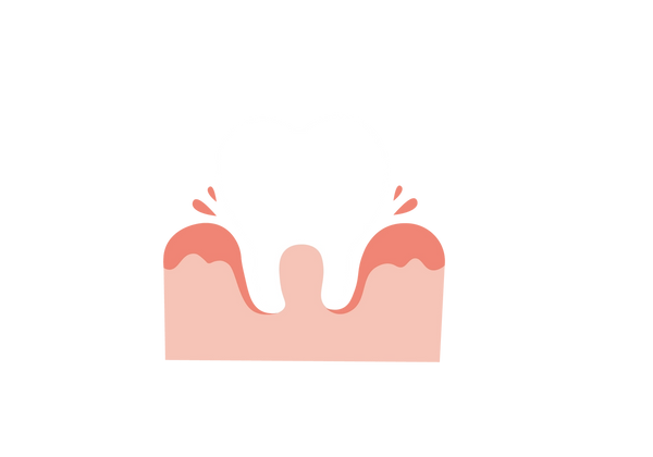 Uma ilustração de um dente branco incrustado em uma gengiva rosa. A parte superior da gengiva é rosa escuro e duas gotas rosa escuro vêm de onde o dente fica na gengiva.