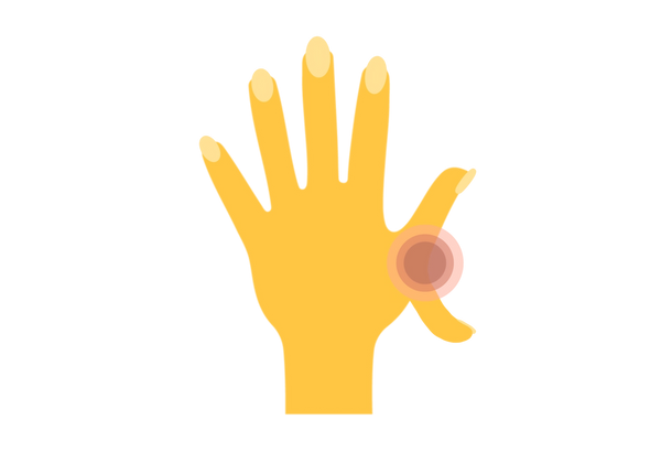Illustration d'une main déformée par l'anémie de Fanconi. La main est jaune et un pouce supplémentaire dépasse de la main. Des cercles concentriques rouges émanent de l’endroit où le pouce rencontre la main.