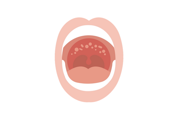Open mouth with sores on the roof of the mouth.