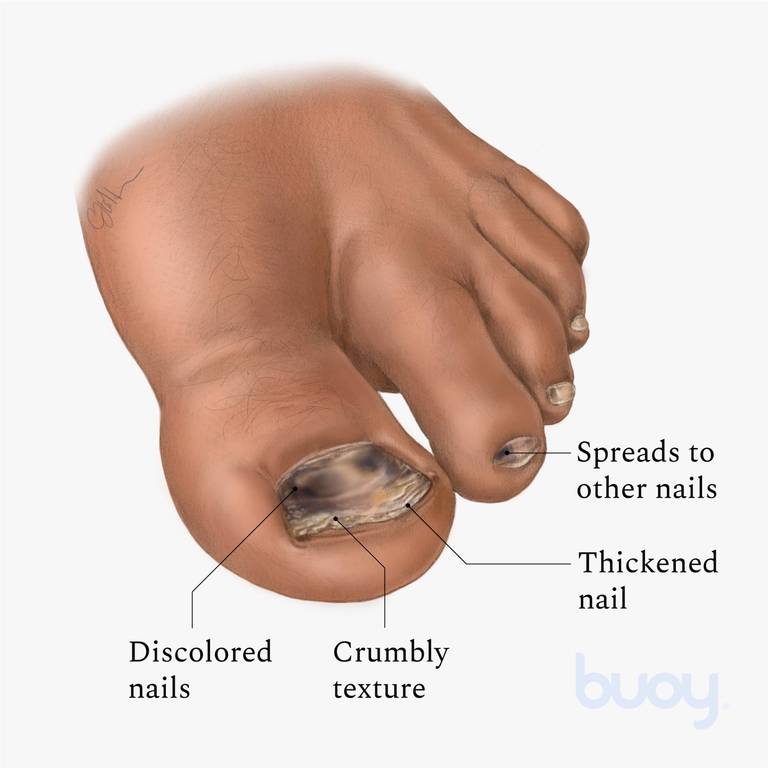 why is my toenail black , why is my urine bright yellow