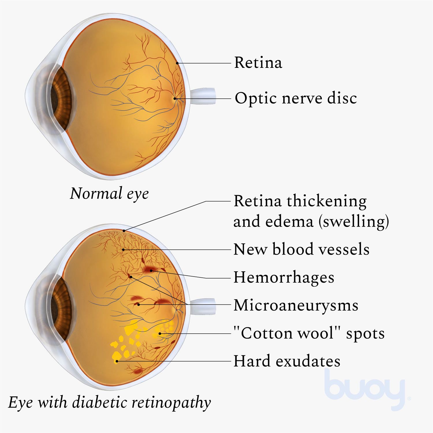 Diabetische Retinopathie   Ursachen, Symptome, und Behandlungen  