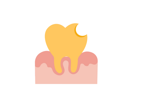 Una ilustración de un diente amarillo con un gran círculo recortado en la parte superior derecha. Está incrustado en una goma de color rosa claro con manchas de color rosa más oscuro en la superficie.