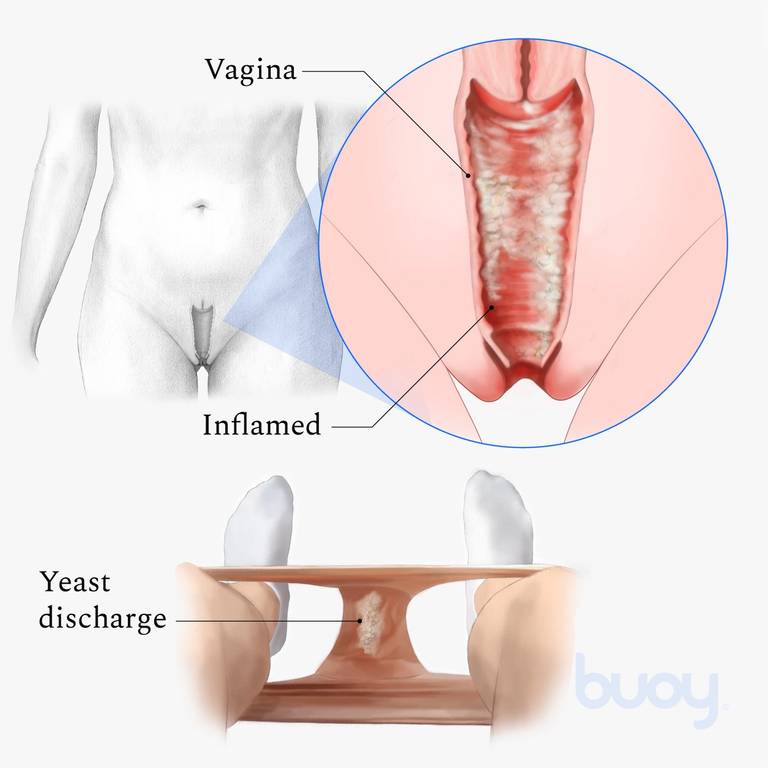 Vaginal yeast infection Information