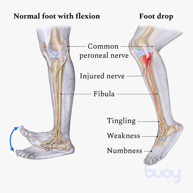 Foot Drop: Causes, Symptoms & Treatment