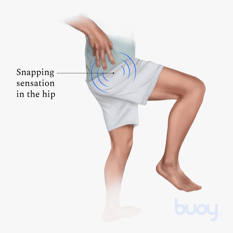 Neerduwen Verzoekschrift Automatisch Snapping Hip Syndrome | Symptoms & How to Treat It