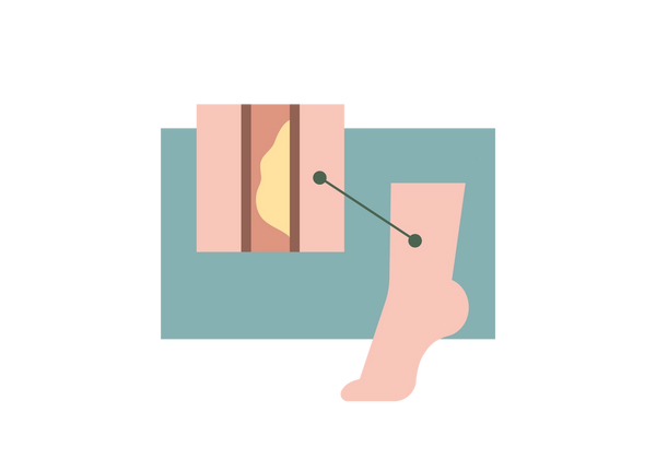 An illustration of a light peach-toned foot mid-step, with only the toes and ball of the foot on the ground. A dark green line connects a spot on the upper ankle to a cross section of an artery in the upper lefthand corner of the illustration. The borders of the artery are dark red and a large light yellow obstruction is on one side. The rest of the artery is light pink and the set of images is in front of a medium green rectangular background.