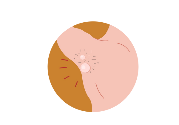 An illustration within a mustard yellow circle of a man's right armpit and shoulder with his arm raised. His skin is light peach-toned, and there are two lighter large lumps in his armpit, surrounded by grey medium length armpit hair. Four red lines come from the lumps.
