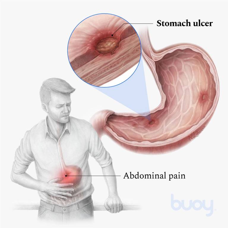 stomach ulcer pain location