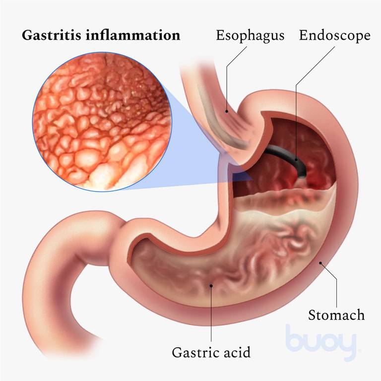 gastritis treatment