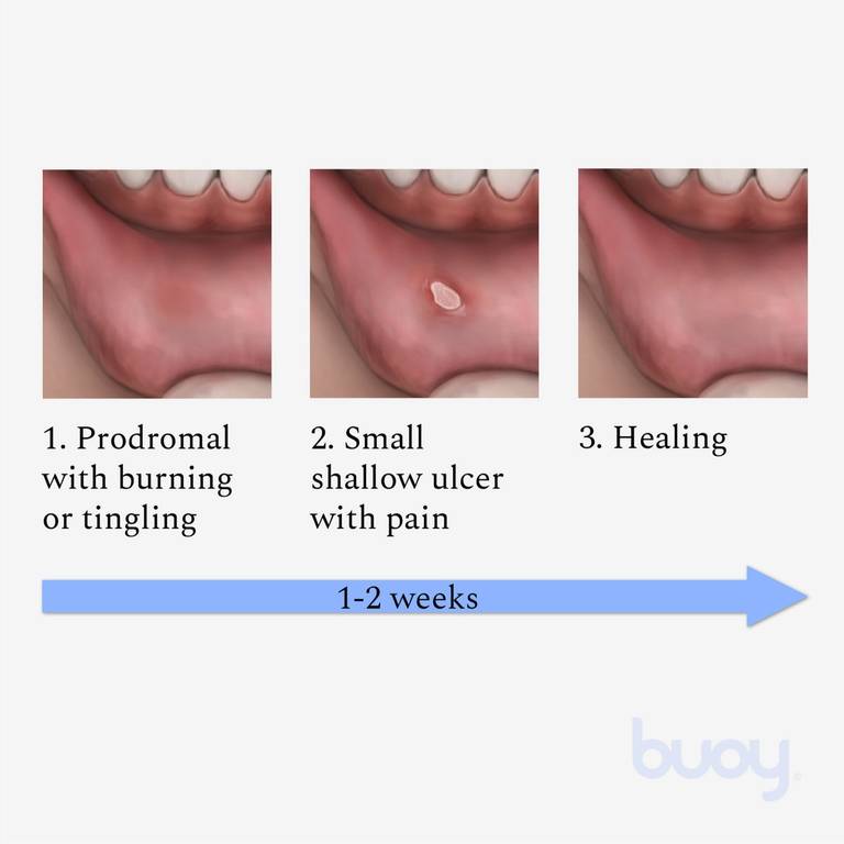 canker sore stages