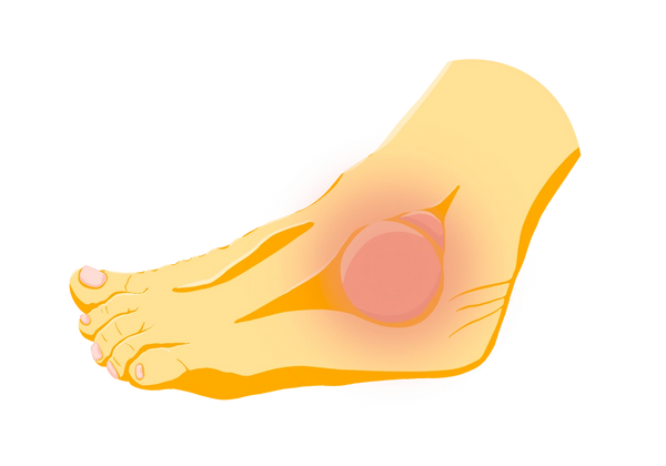 Uma ilustração de um pé amarelo com uma protuberância grande e uma protuberância menor acima dele, no tornozelo. O pé está irregular. Um círculo gradiente vermelho sai dos caroços, mostrando dor e inchaço.