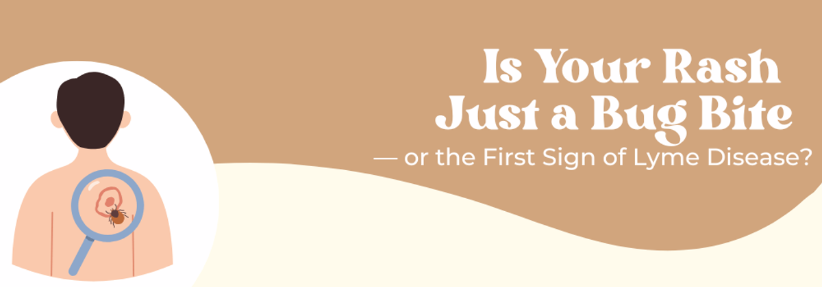 Is Your Rash a Bug Bite — or the First Sign of Lyme Disease?