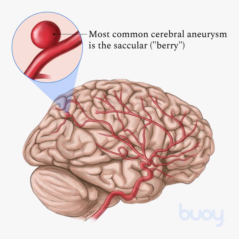 Brain Aneurysm | Types of Aneurysms & When to Go to the ER