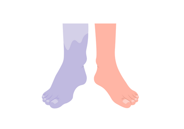 Eine Illustration von zwei Füßen. Der linke Fuß ist hellviolett und größer als der rechte Fuß, der einen leichten Pfirsichton hat und keine Schwellung aufweist. Der linke Fuß hat am Schienbein oberhalb des Knöchels einen helleren Lilaton.