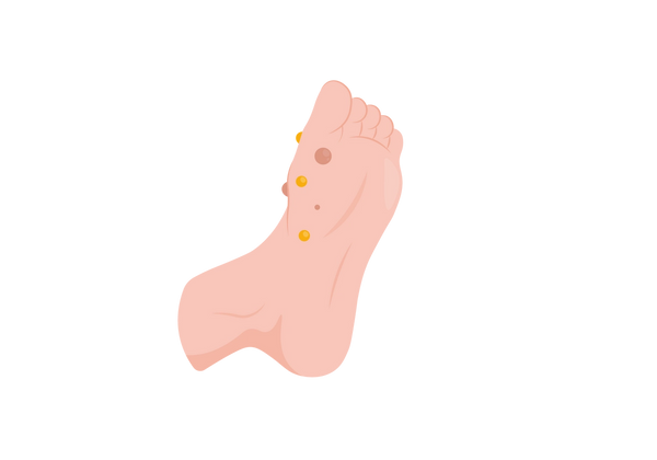 Uma ilustração da parte inferior de um pé em tom de pêssego claro com um aglomerado de pequenas saliências arredondadas amarelas e vermelhas escuras perto do dedão do pé.