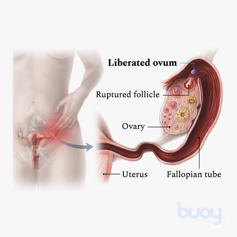 Mittelschmerz ou douleur d'ovulation à mi-cycle | Pourquoi cela arrive