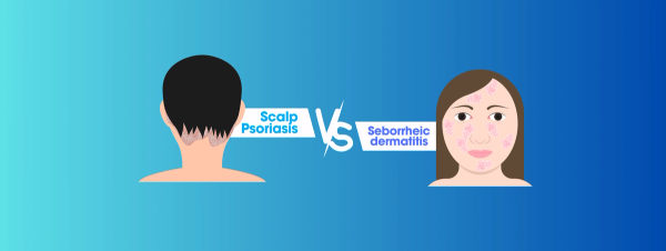 Scalp Psoriasis vs. Seborrheic dermatitis