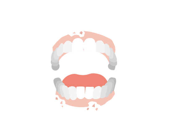 Uma ilustração de uma mandíbula aberta com gengivas rosadas e dentes brancos. As gengivas rosadas estão apodrecendo.