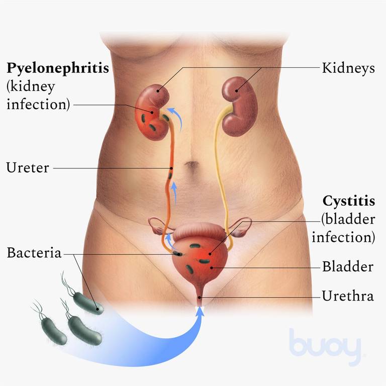 Infection des voies urinaires | Ce que vous devez savoir pour ...