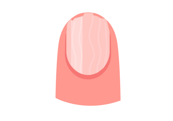 Uma ilustração de uma ponta de dedo com um leito ungueal avermelhado e uma unha clara com linhas onduladas. A parte superior da unha está irregular e quebrada. O dedo é um tom pêssego médio e a unha é um tom pêssego mais claro.