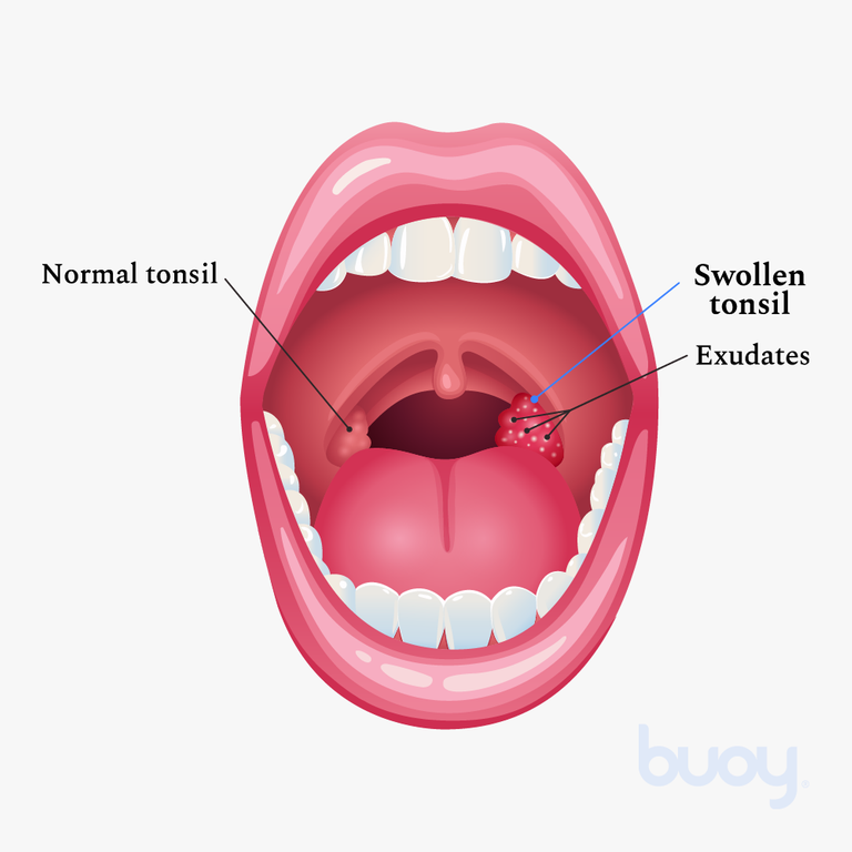 normal throat vs strep throat