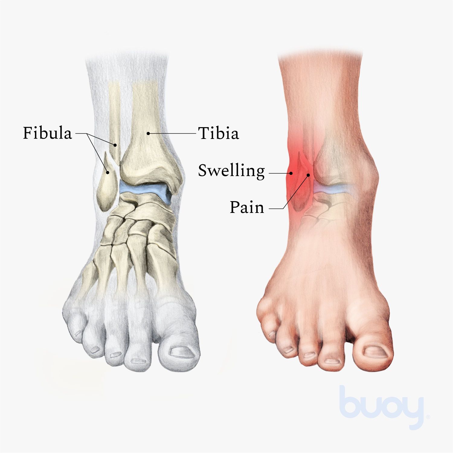 Top 4 signs Your Ankle Injury Is Serious | Sol Foot & Ankle Centers
