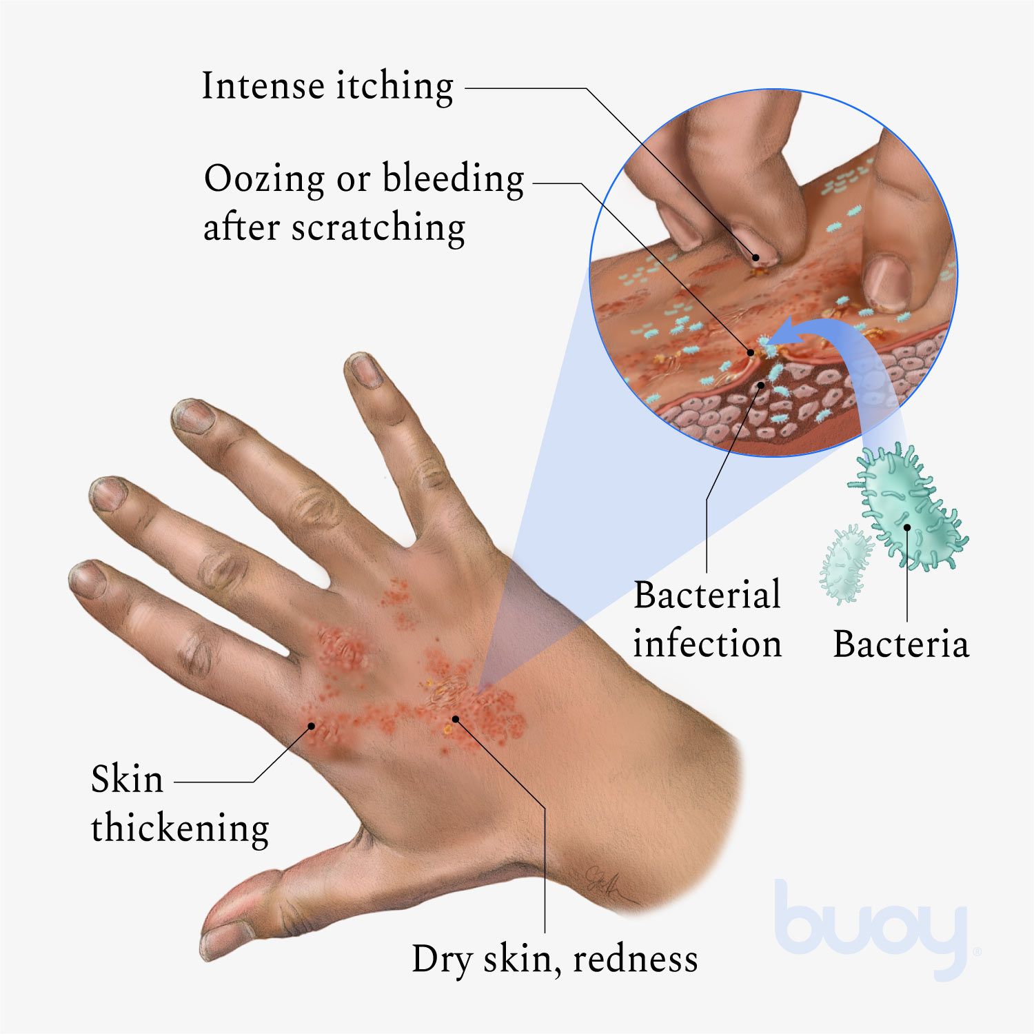 Eczema  Causes of Eczema (Atopic Dermatitis) and How to Treat It