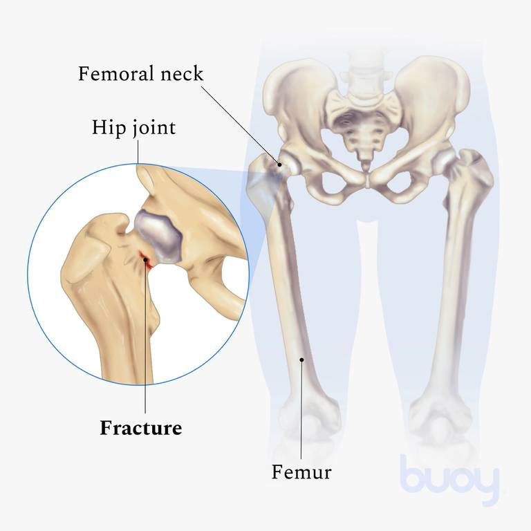 Femoral Stress Fracture | Symptoms, Treatment, and Prevention