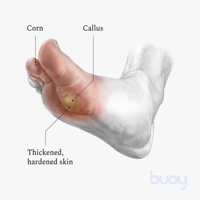 Calluses on the feet: how to get rid of the horn?