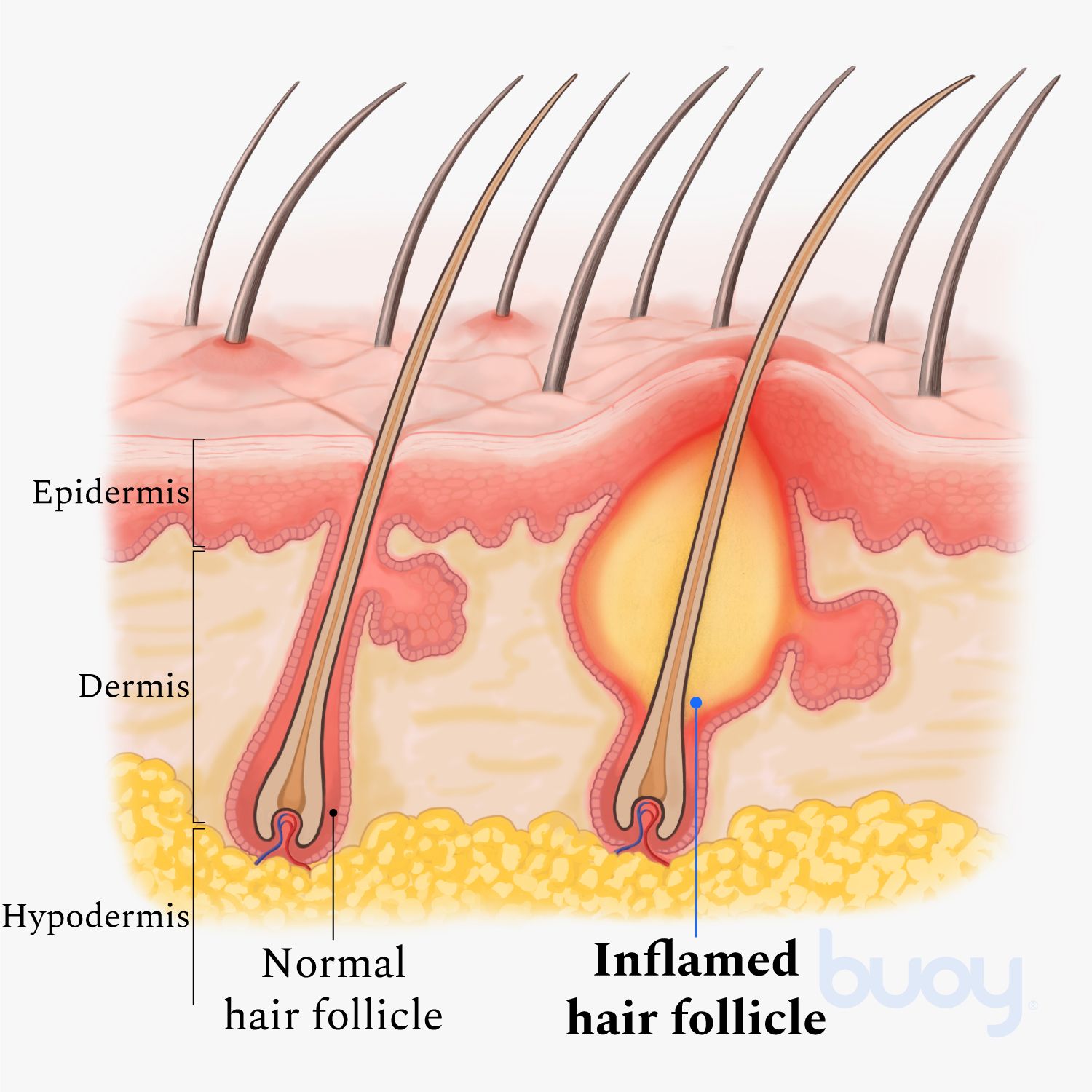 Inflamed chest hair follicles  Stock Image  M1600086  Science Photo  Library