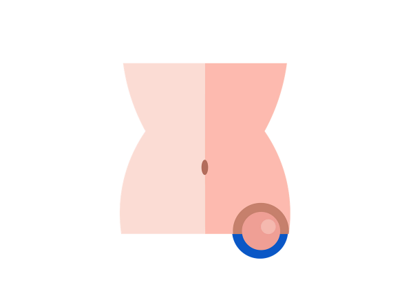 Ein Knoten im linken Unterbauch