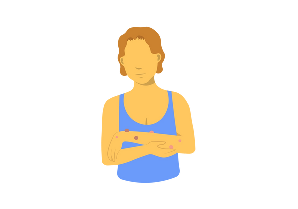 An illustration of a woman from the waist up looking down at her left arm, being held up in front of her by her right arm. There are varying shades of pink and red bumps on her left arm, and the rest of her skin is yellow. She has short, curly light brown hair and is wearing a light blue loose tank top.