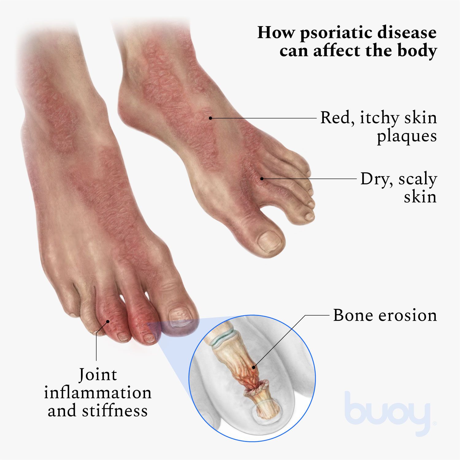 Psoriasis on the Feet: Symptoms, Causes and Treatment