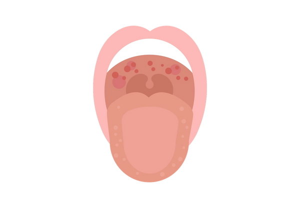 Ein offener Mund mit herausgestreckter Zunge, der rote Flecken im Mund zeigt.