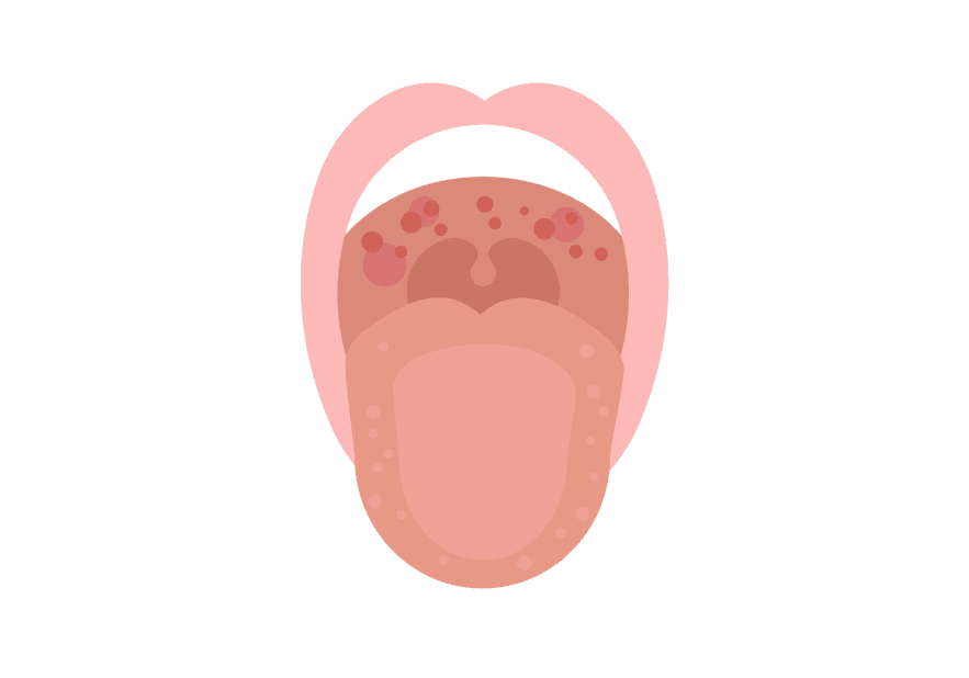 Red Spots In The Mouth How To Treat Red Spots On Roof Of Mouth