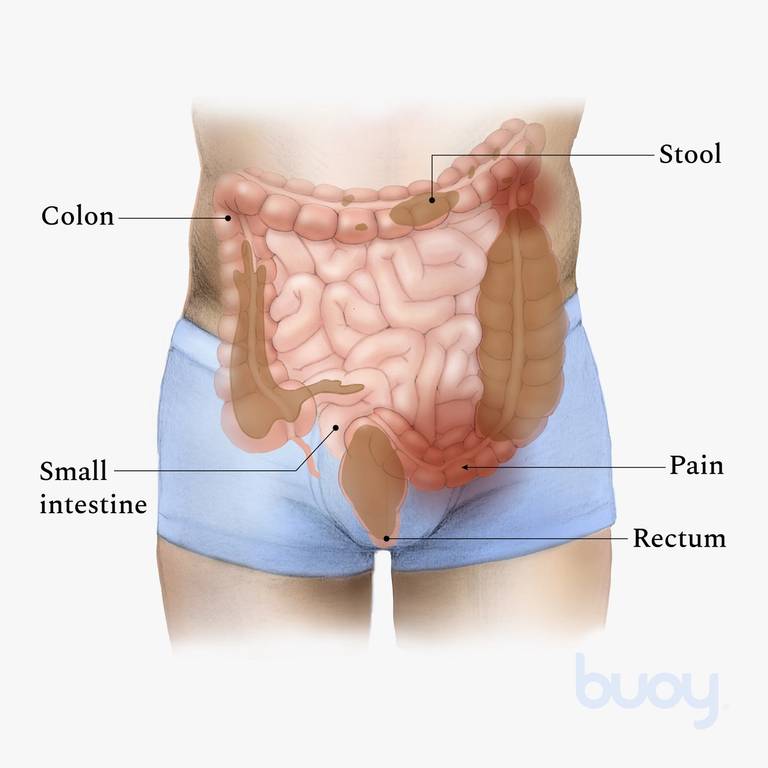 Constipation | 4 Ways to Treat Constipation | Buoy Health