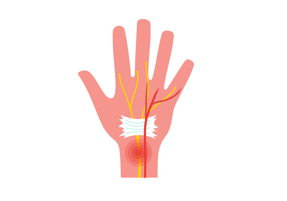 Carpal Tunnel Syndrome: Causes, Symptoms, and Treatments - Orthopedic &  Sports Medicine