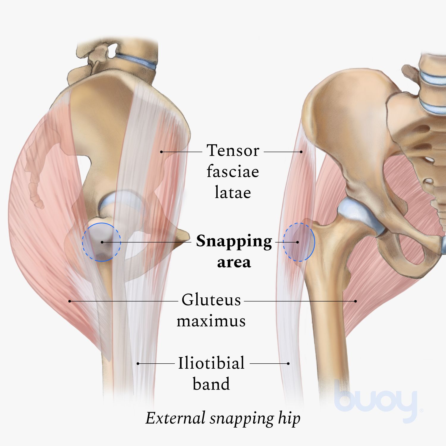 Snapping Hip Syndrome  Symptoms & How to Treat It