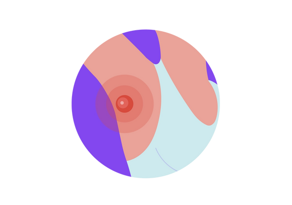 Illustration dans un cercle violet représentant l’aisselle d’une femme avec le bras levé. Elle a la peau de couleur pêche clair à moyen et il y a une bosse rouge vif sous son aisselle avec un cercle plus petit et plus clair à l'intérieur et un autre à l'intérieur de celui-ci. Deux cercles concentriques translucides rouges proviennent de la bosse. Elle porte un débardeur vert clair.