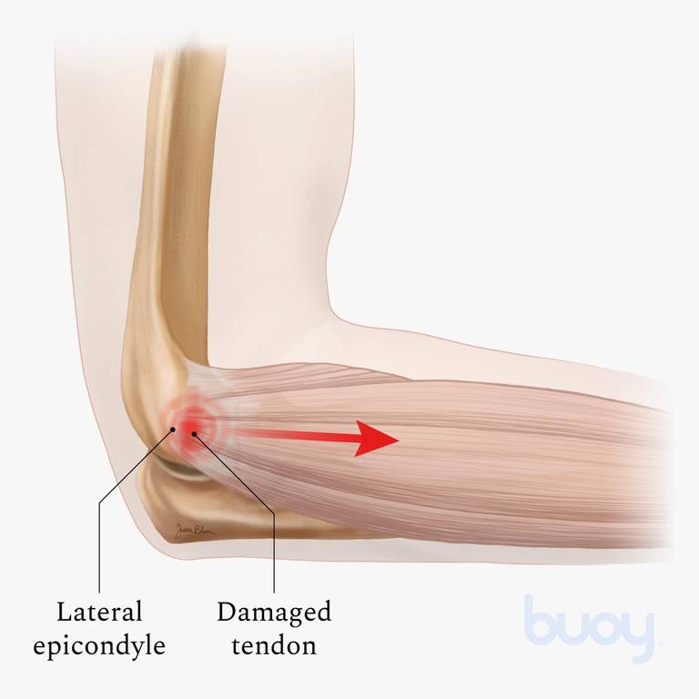 Tennis Elbow | Reasons Your Elbow Hurts & Best Treatments | Buoy