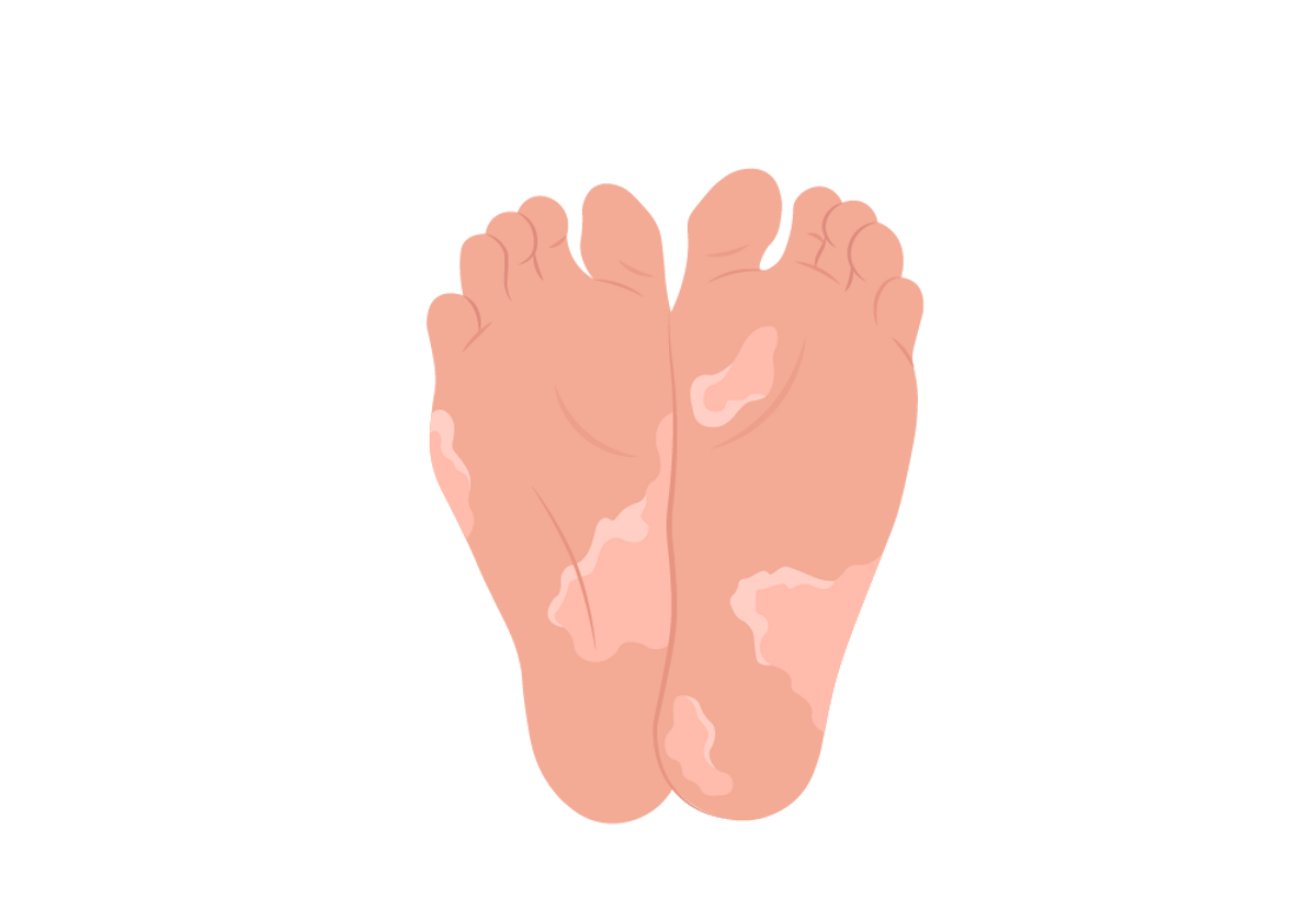 What Causes Peeling Feet, Why is the Skin Peeling on my Feet