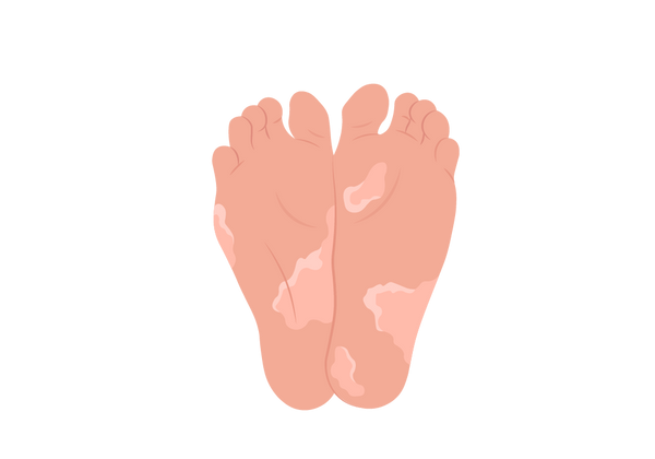An illustration of two feet next to each other. The soles are covered in light peach-toned splotches, and the skin is slightly darker peach-toned. Each splotch has lighter splotches around the border.
