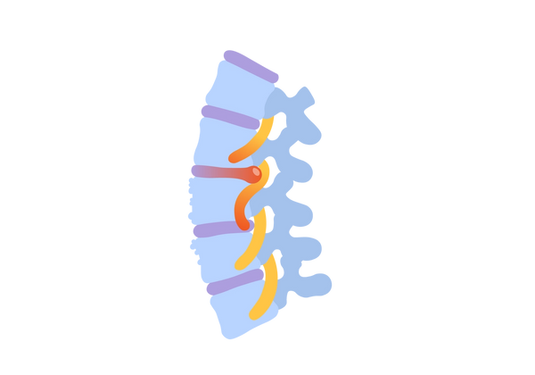 An illustration of the top section of the spine. It's light blue, and it shows pressure and inflammation of the spinal cord.