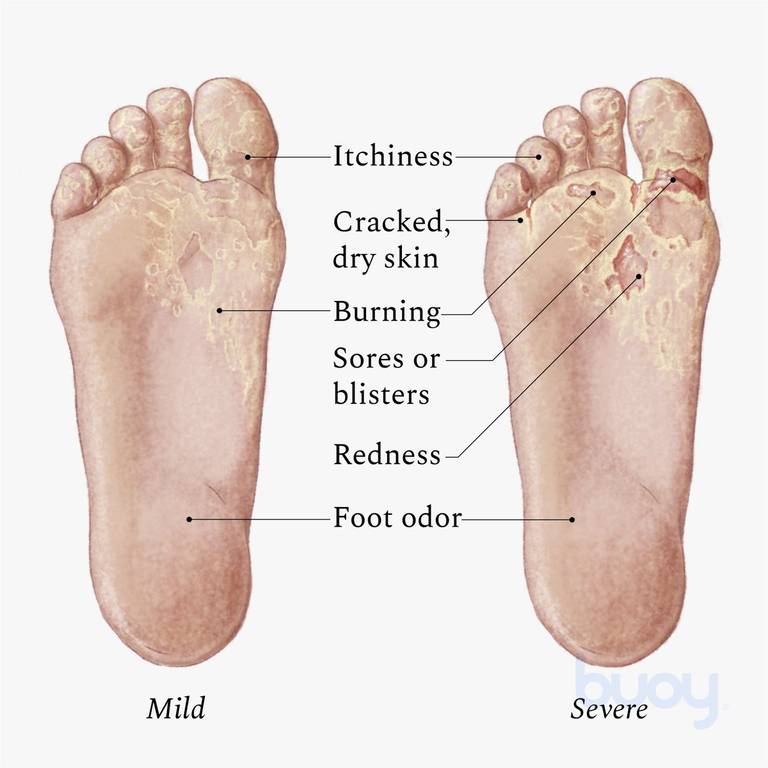 9 Red Feet Causes What You Need To Know About Foot Redness