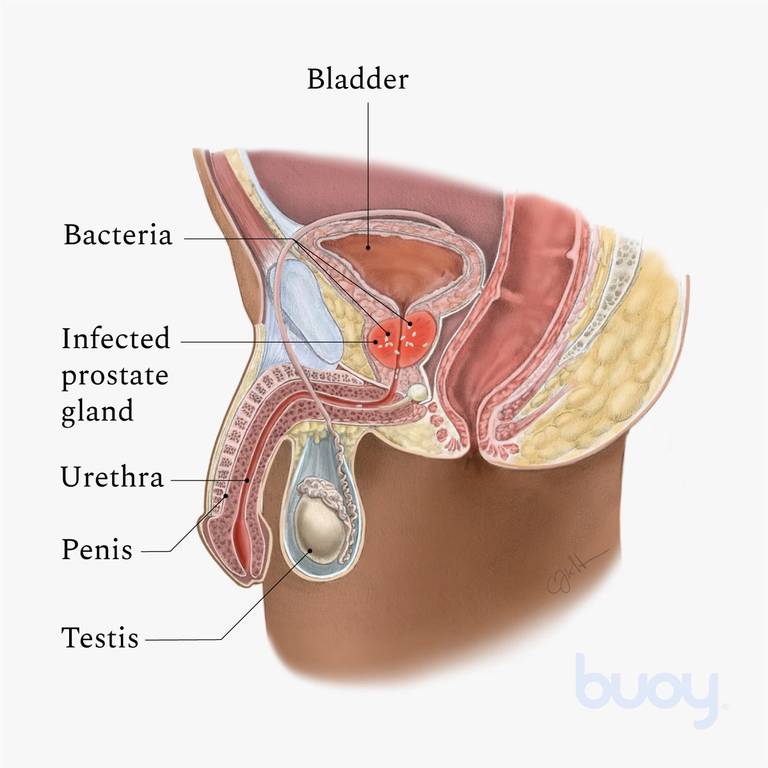 vesicar a prostatitis alatt