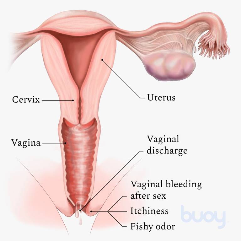 Bacterial Vaginosis and Abnormal Vaginal Discharge: Causes, Symptoms, and  Treatment