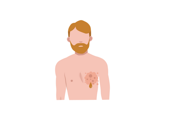 Mann mit Bart und einem rosa Fleck auf der linken Brust. Aus dem Fleck tropft ein brauner Tropfen.
