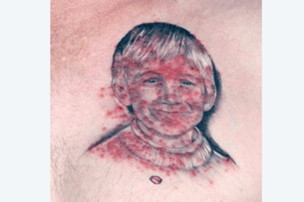 Edmonton woman warns of henna tattoo risks after serious allergic reaction  | CBC News