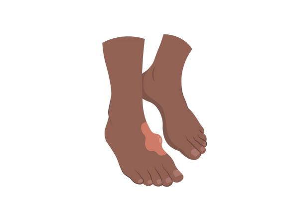 Ilustração de dois pés em tom chocolate marrom escuro, no meio do passo. O pé na frente tem uma mancha vermelha mais clara na parte interna da parte superior do pé, com uma grande protuberância projetando-se da área vermelha.
