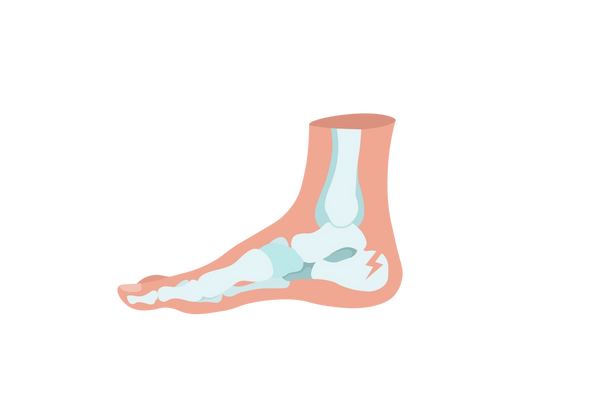 Una ilustración de una sección transversal de un pie con los dedos apuntando hacia la izquierda. La piel es de color melocotón claro y los huesos de color verde claro son visibles a través de la piel. El hueso del talón tiene una grieta en forma de rayo y tres líneas blancas cortas salen de la fractura.